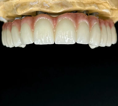 Implantes dentales