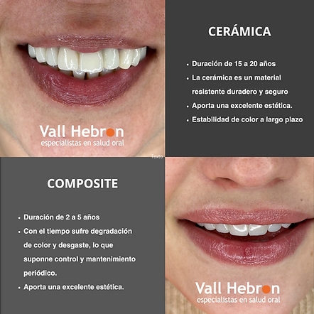 Diferencias entre diseños de sonrisa en composite y cerámica