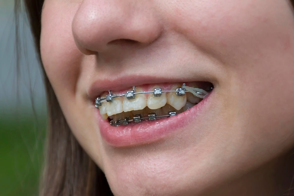 Close-up of a smiling patient showing metal braces on teeth – braces for overbite in Avon and Torrington, CT.