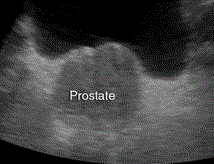 Prostate Ultrasound Scan