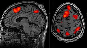 A Medial and Superior view of an image of a brain during a Functional MRI study.