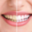 teeth-Whitening