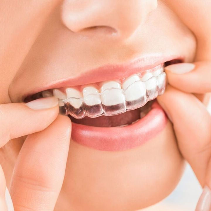 Aligners Treatment At Dr. Pragna's Max Care Dental In Medipally