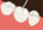 Tooth fillings Treatment In Dr. Pragna's Max Care Dental