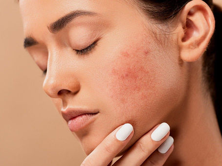 Skin Barrier Rusak?