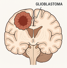 Image showing malignant brain tumors, information about glioblastoma