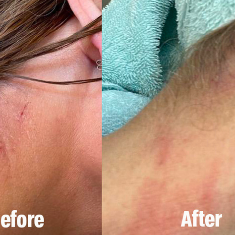 Got Psoriasis? bFREE with PsoFree