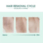 Thumbnail: Laser IPL Hair Removal