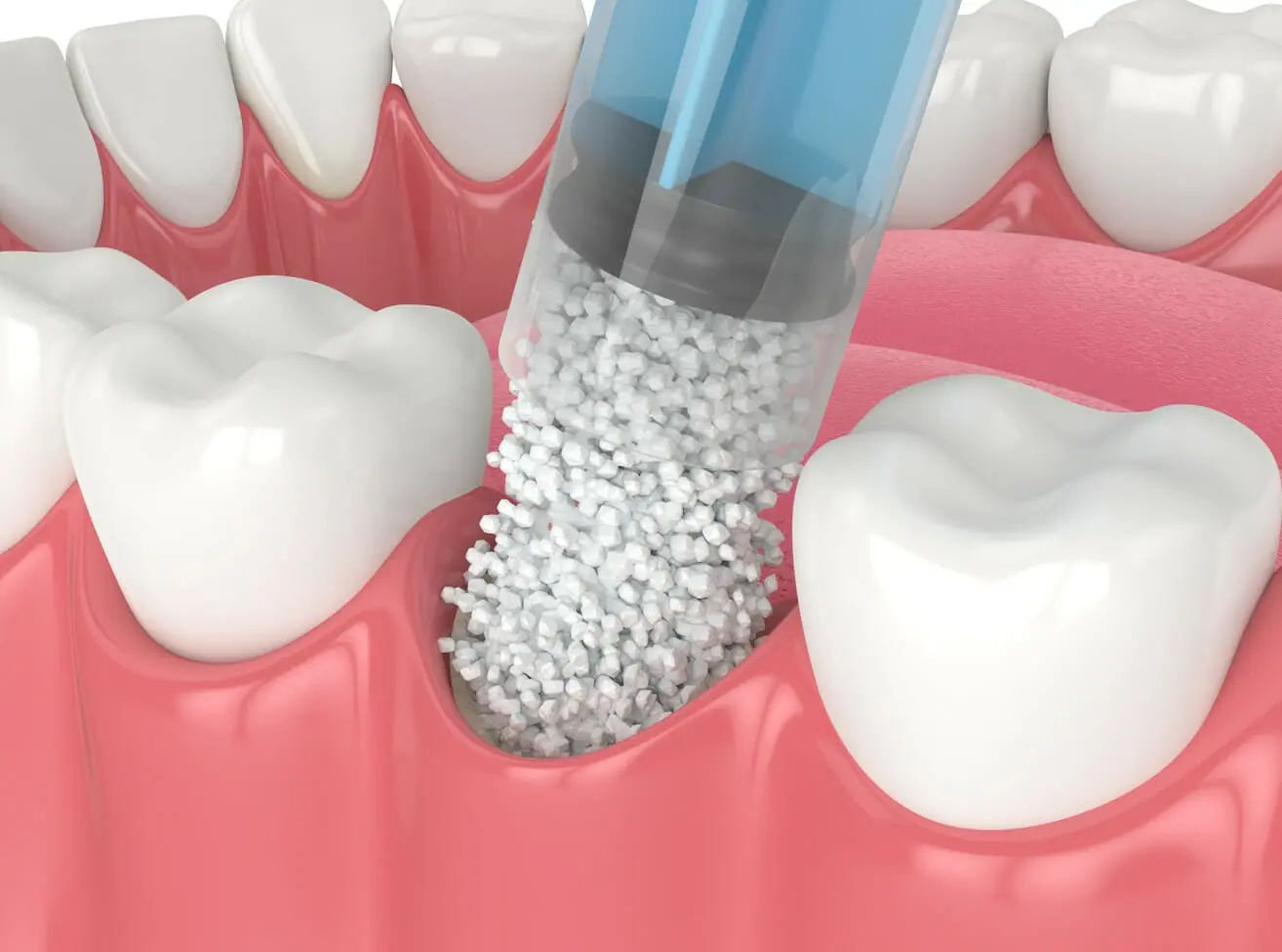 bone-graft-dental.webp