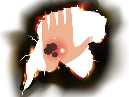 How to Identify Different Types of Burns