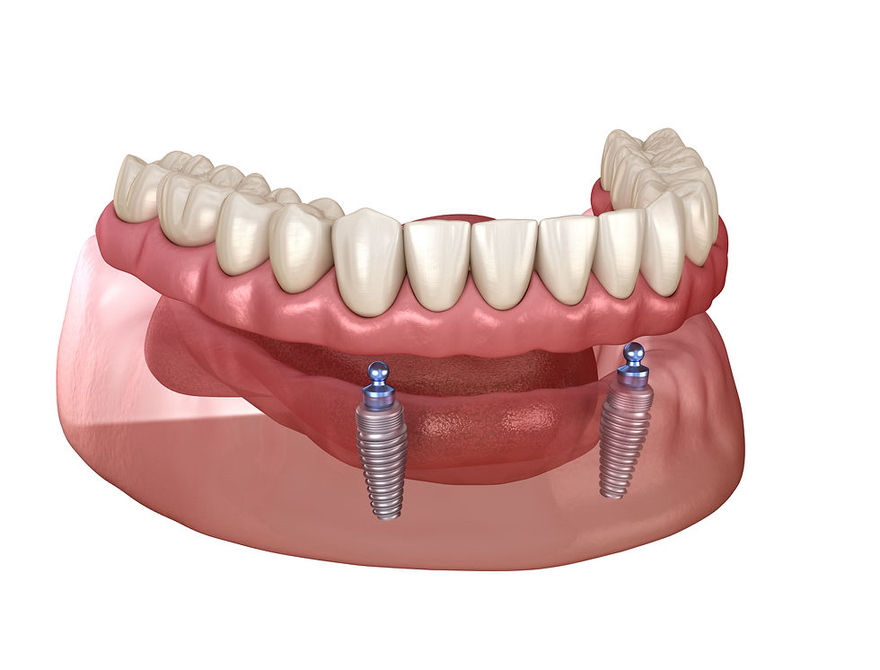 Patentos implantátumos fogsor szemléltetése.