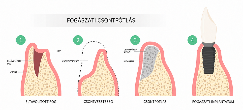 Irányított csontregeneráció sematikus bemutatása