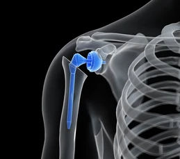 What to Expect After Reverse Shoulder Replacement