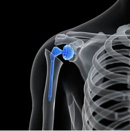 What to Expect After Reverse Shoulder Replacement