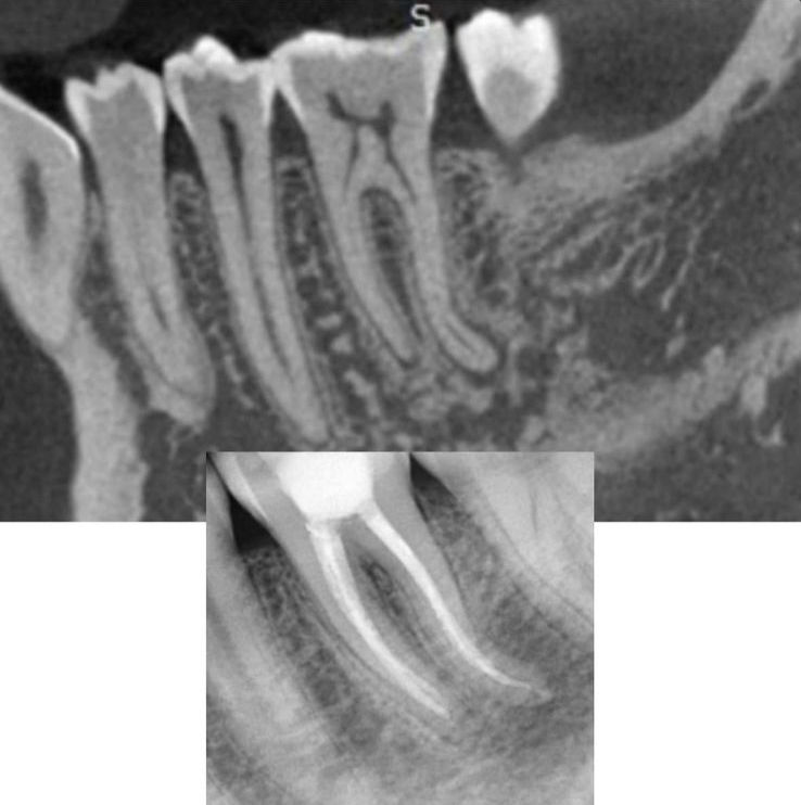 Dor de Dente: Por que o Alívio Pode Enganar e o Problema Persistir