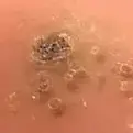 cryotherapy-verrucae-150x150.webp