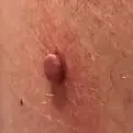 冷冻疗法-皮肤赘生物-150x150.webp