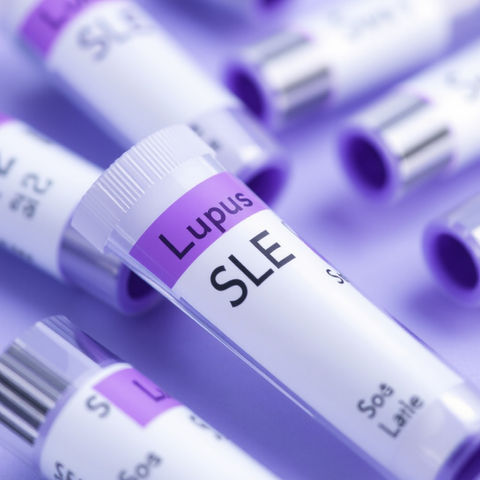 Test tubes labeled Lupus SLE, for medical research and trials.