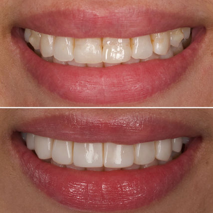 composite-bonding-veneers-before-after-bristol.jpg