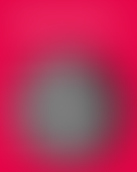 Illustration des dents de sagesse couchées dans la mâchoire