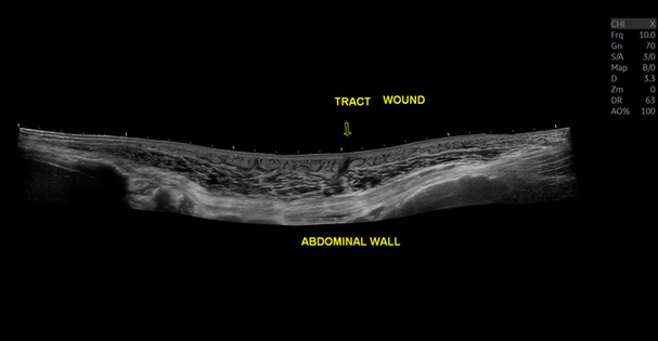 Ecografía de imagen panorámica de pared abdominal con tecnología de vista extendida