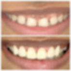 dental implant pune3