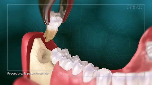 Burute Dental sURGERY in pimpri chinchwa