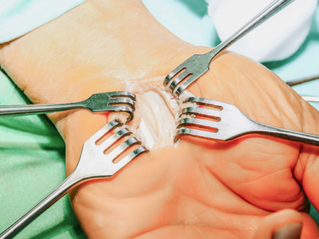 Carpal Tunnel: How Your Wrists Are Sending You an SOS