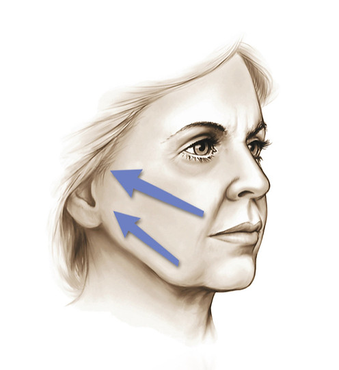 Slides Patient Education - Facelift Neck