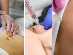 Exploring Facial Rejuvenation: Fat Grafting