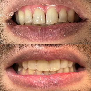 Cierre de espacios con Resina.png