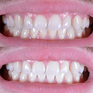 Blanqueamiento Dental .png