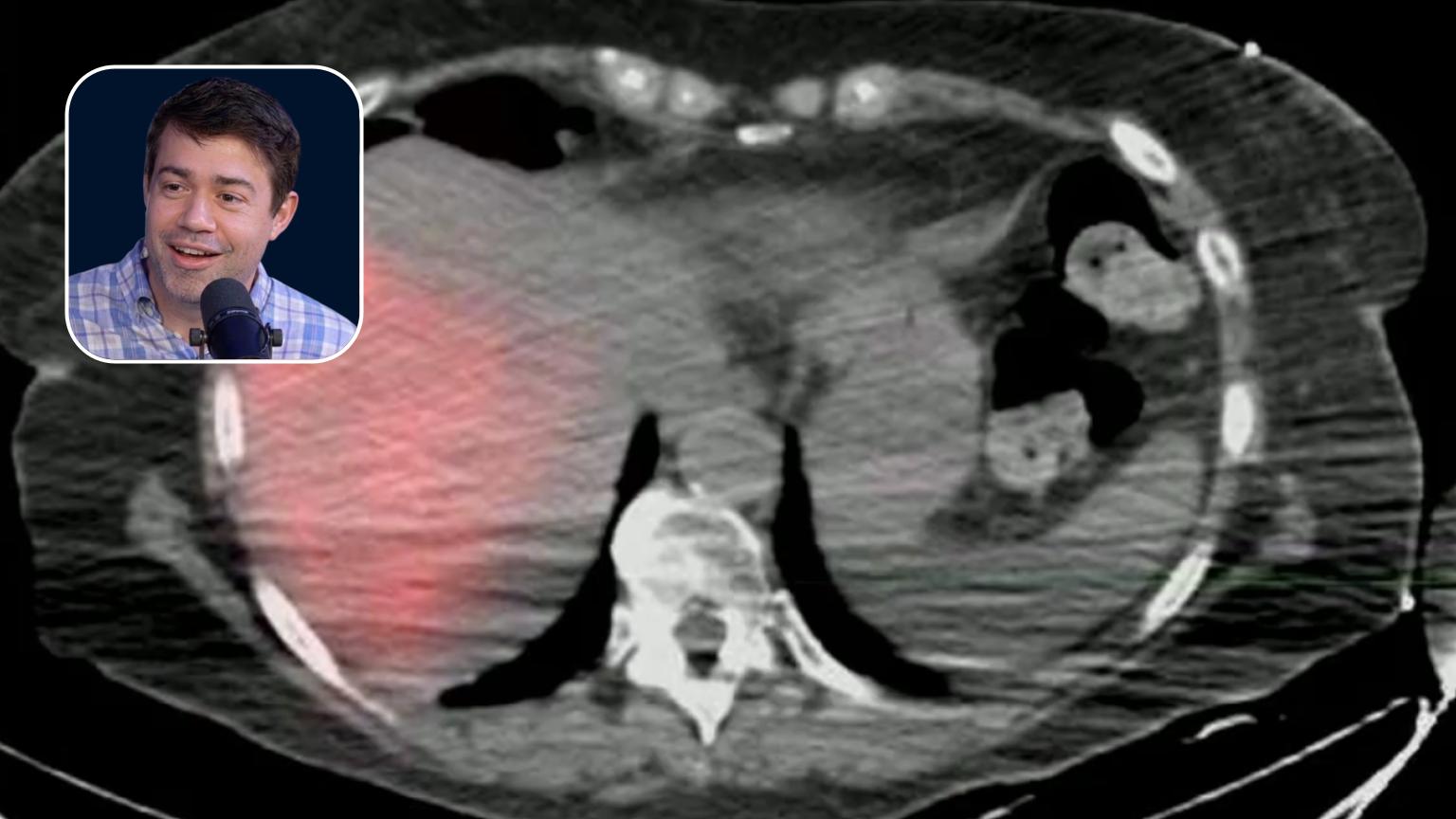 Y90: Ablation vs. Radiation Segmentectomy for Multifocal Colorectal Cancer