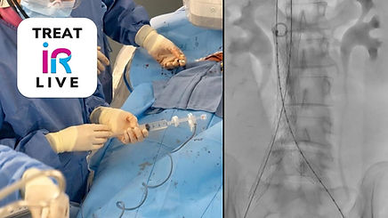 TREAT iR LIVE: IVC Recanalization (October 2024)