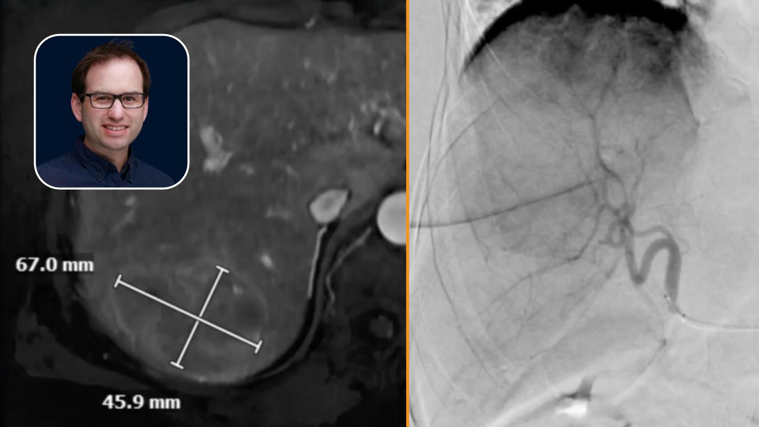 Y90 Radioembolization: Lobar Neuroendocrine Tumor (NET) Treatment with Advanced Catheter Techniques