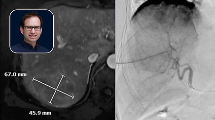 Y90 Radioembolization: Lobar Neuroendocrine Tumor (NET) Treatment with Advanced Catheter Techniques