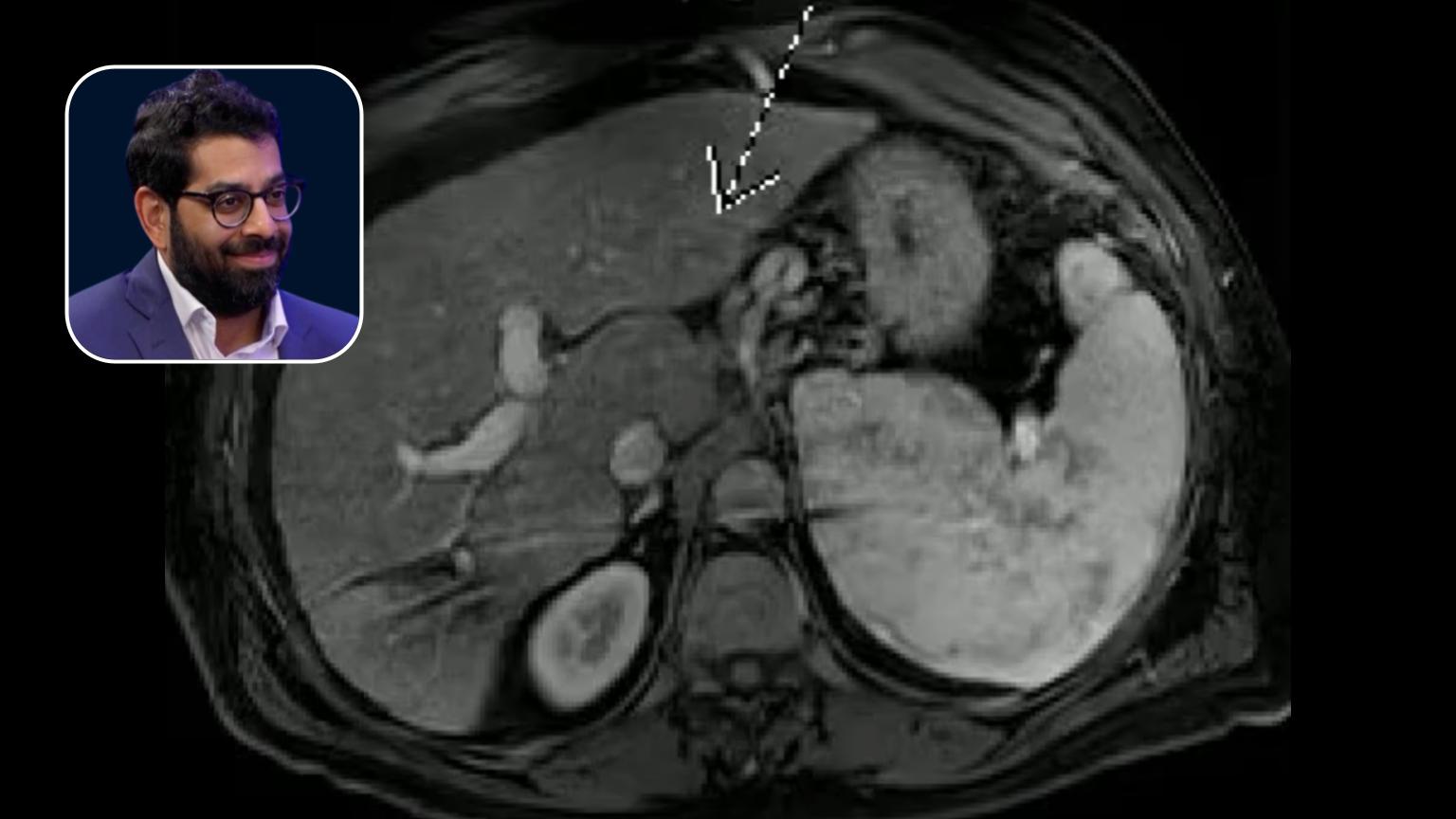 Y90: Downstaging Multifocal HCC Lesions to Transplant