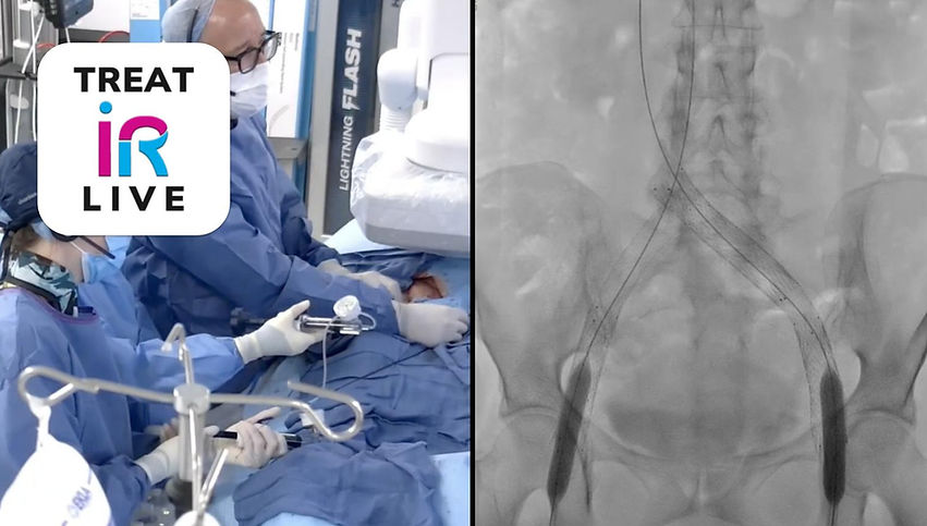TREAT IR Live: Occluded Venous Stent Recanalization (April 2026)