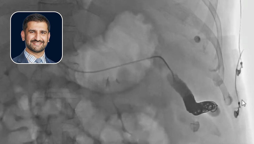 TIPS & Portal Vein Reconstruction with Concomitant Hepatic Artery Injury