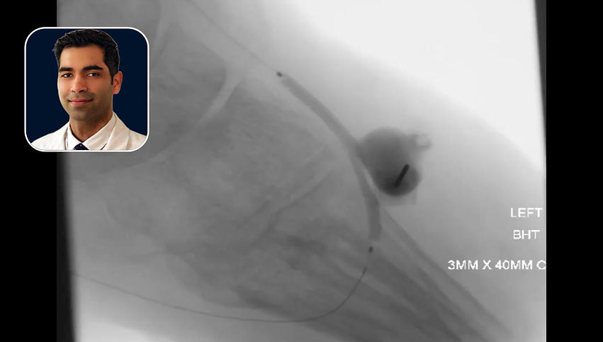 Pedal Loop Reconstruction & Balloon-Assisted Thrombin Injection for Post-TMA Pseudoaneurysm