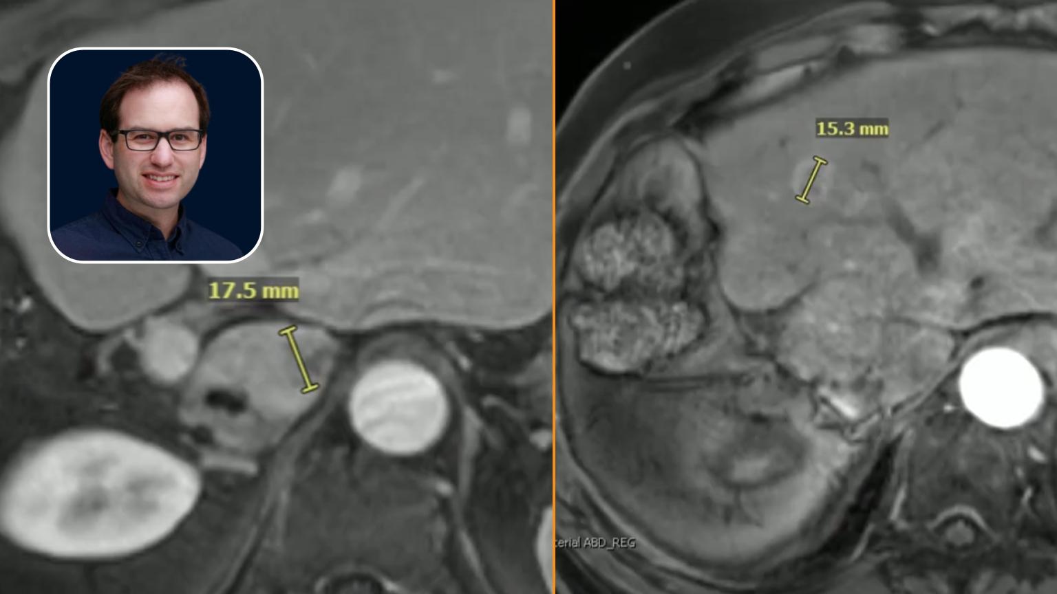 Y90: Multiple mCRC Liver Lesions with Tricky Caudate Lesion