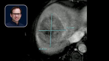 Y90 Radioembolization: Downstaging a 9.3cm Liver Tumor to Transplant