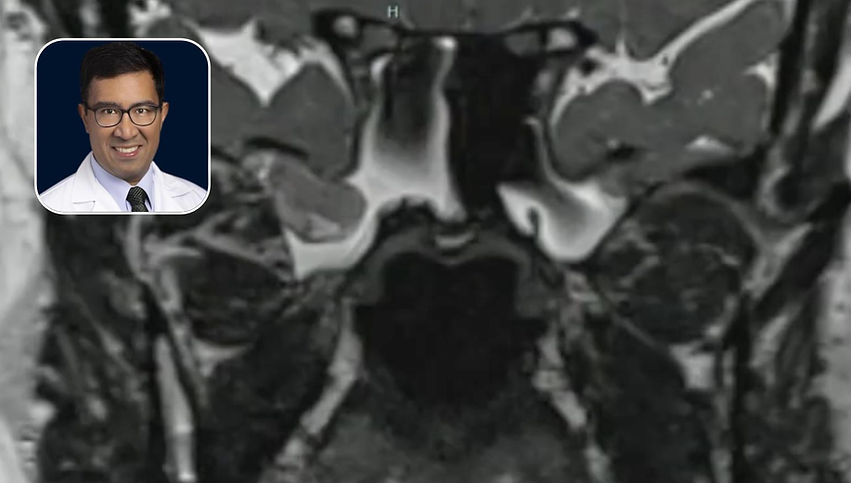 CSF Leak: Bilateral Lateral Sphenoid Recess Encephaloceles