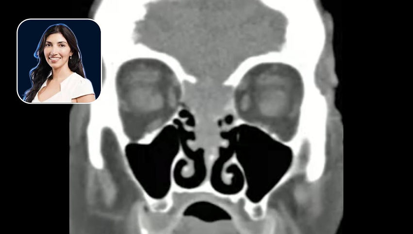 Sinonasal Tumor: Transcribriform Resection of T4b Squamous Cell Carcinoma with Pericranial Flap Reconstruction