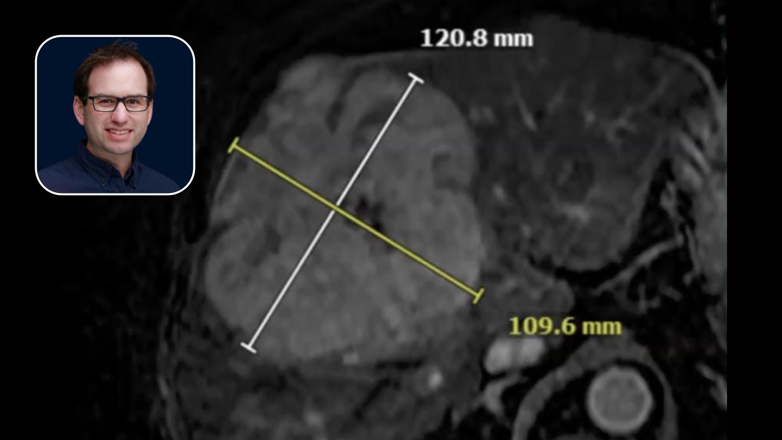 Y90 Radioembolization: Treating Large Liver Tumors with Segmental Embolization Methods