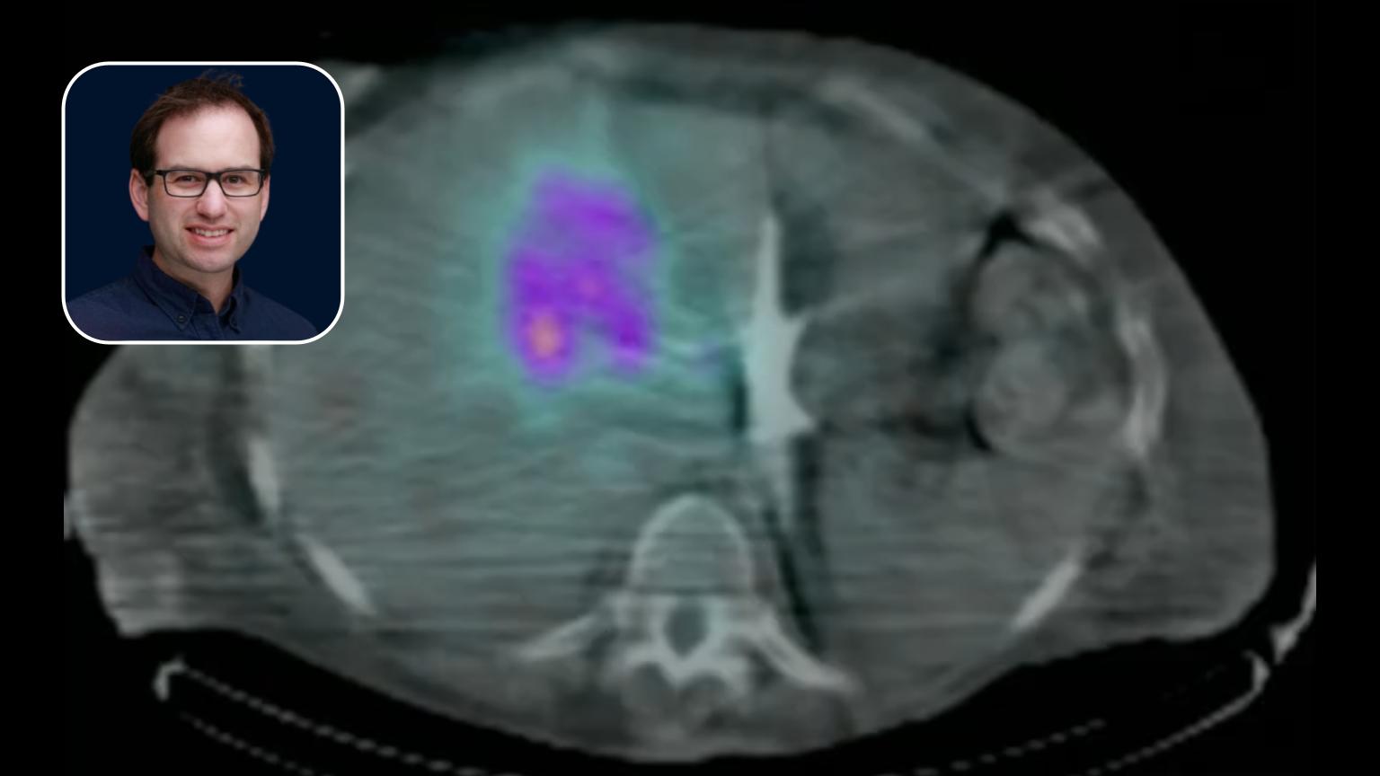 Y90: Large Central Hepatocellular Carcinoma Treatment Approach & Dosimetry