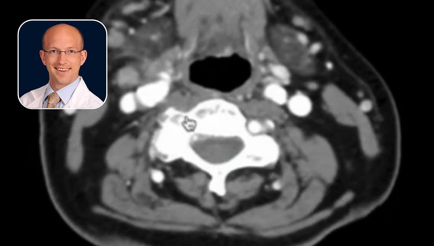 HNC: T2N3 Primary Low Volume Head & Neck Squamous Cell Carcinoma