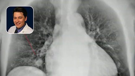 PAP Embolization: Massive Hemoptysis in Patient with History of IVDA