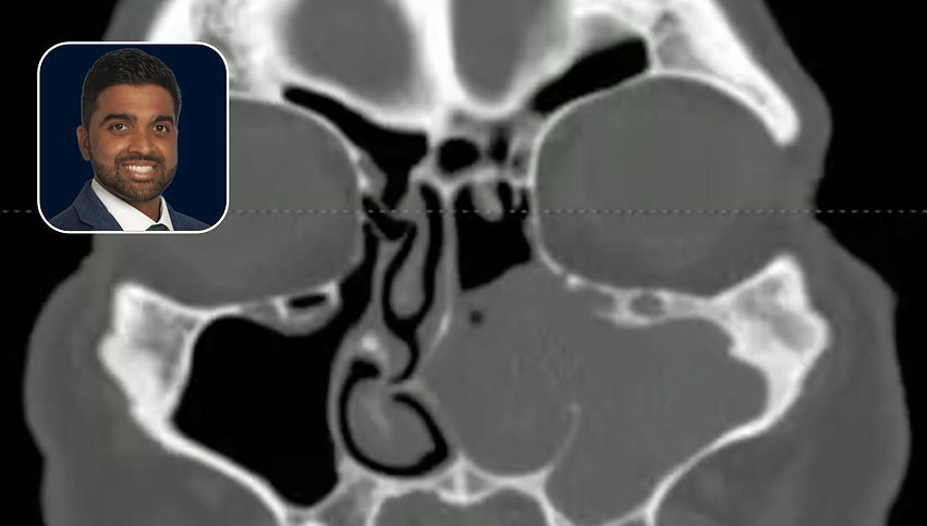 Sinonasal Tumor: Endoscopic Medial Maxillectomy for Management of Inverted Papilloma in the Maxillary Sinus