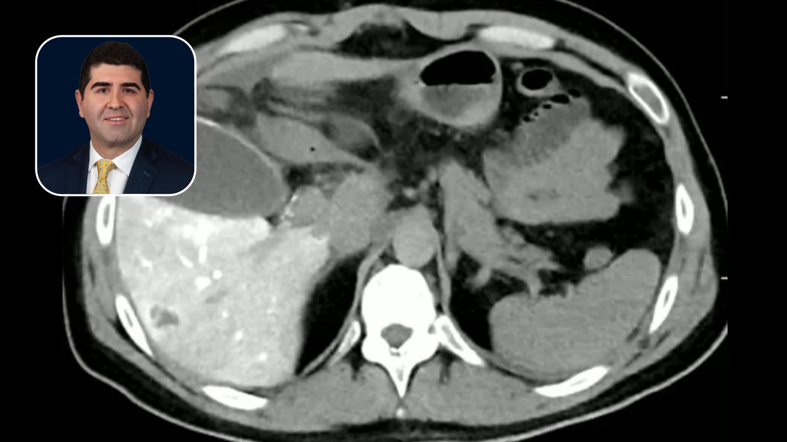 Y90: Treatment Options for a 53-year Old Male with Metastatic Colorectal Cancer & Liver Metastases